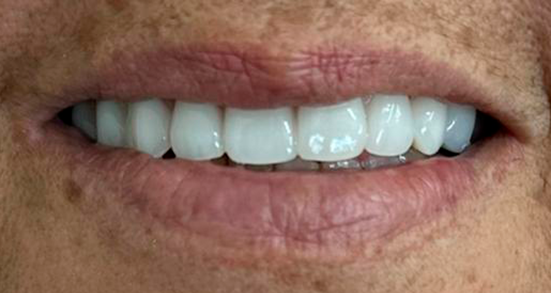 Antes
