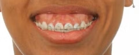 Antes