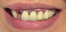 Antes