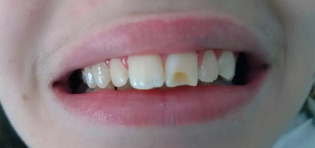 Antes