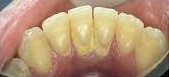 Antes